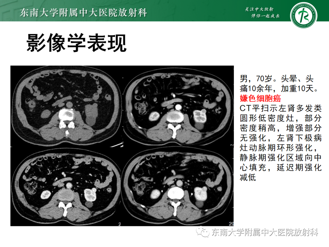 影像PPT - 【PPT】肾嗜酸细胞腺瘤的影像-17