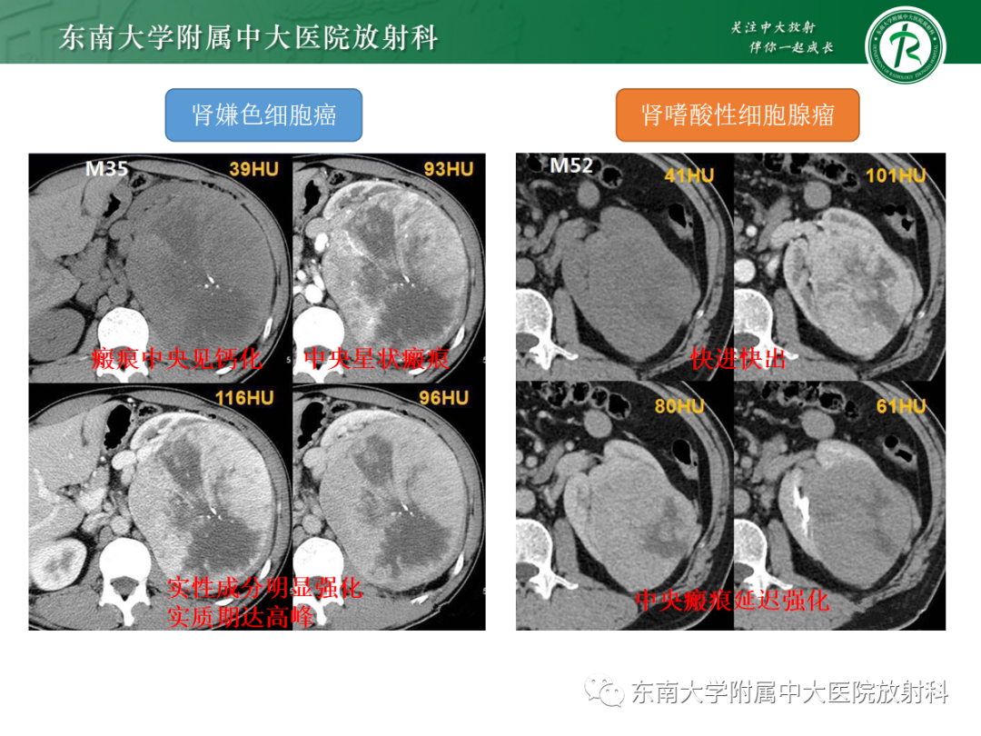 影像PPT - 【PPT】肾嗜酸细胞腺瘤的影像-19