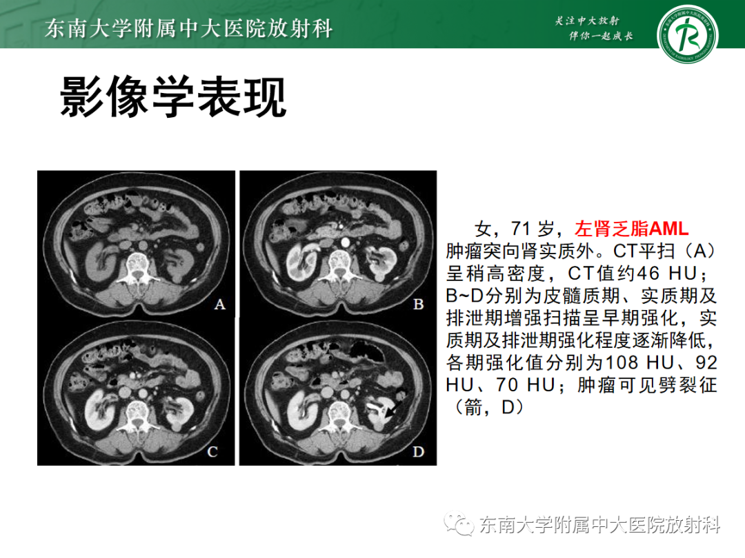 影像PPT - 【PPT】肾嗜酸细胞腺瘤的影像-21