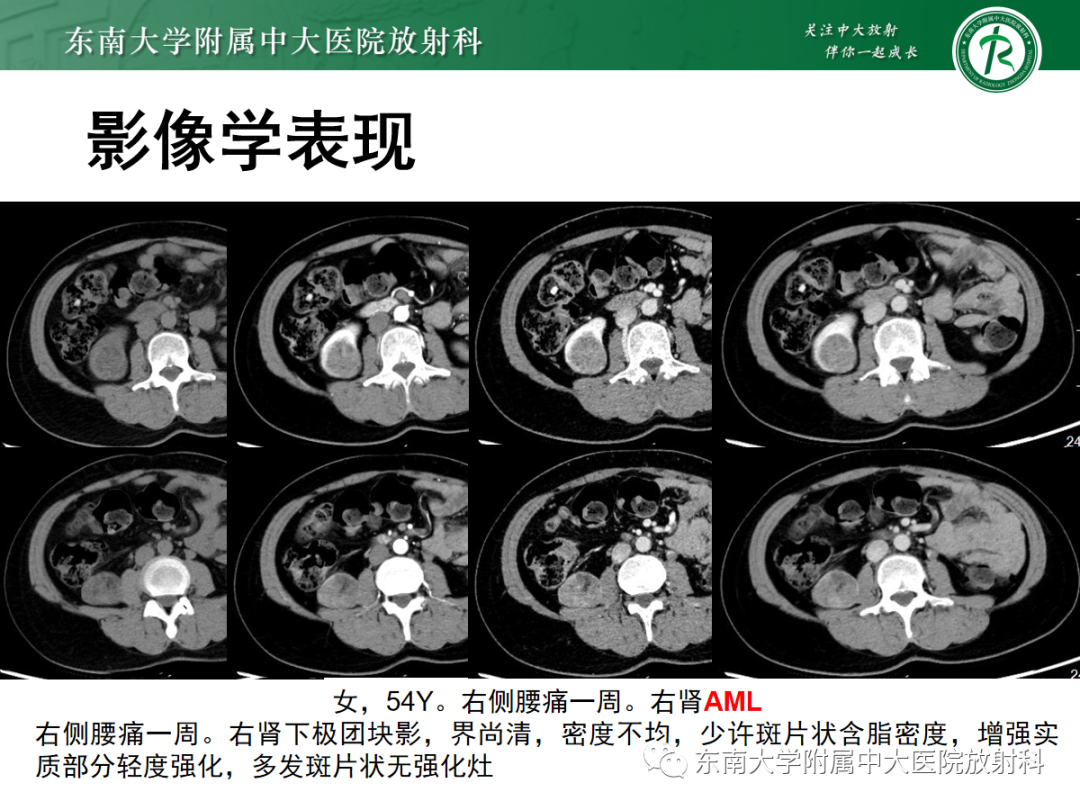 影像PPT - 【PPT】肾嗜酸细胞腺瘤的影像-22