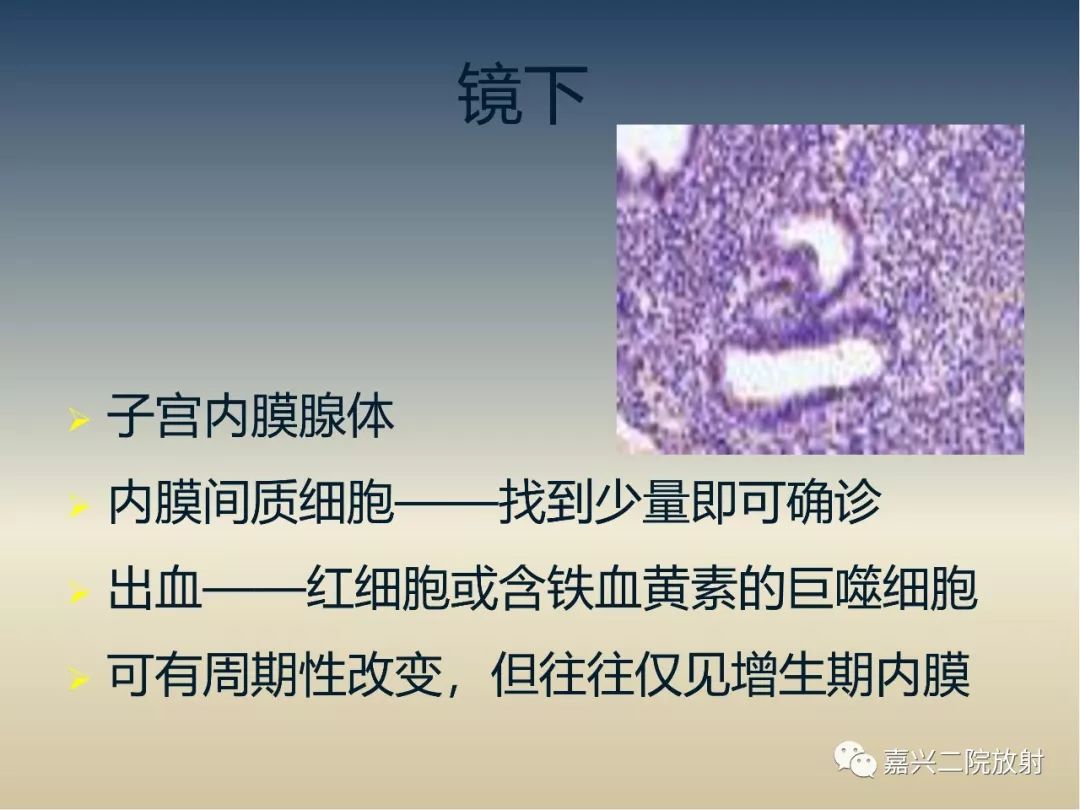 影像PPT - 【PPT】子宫内膜异位症-9