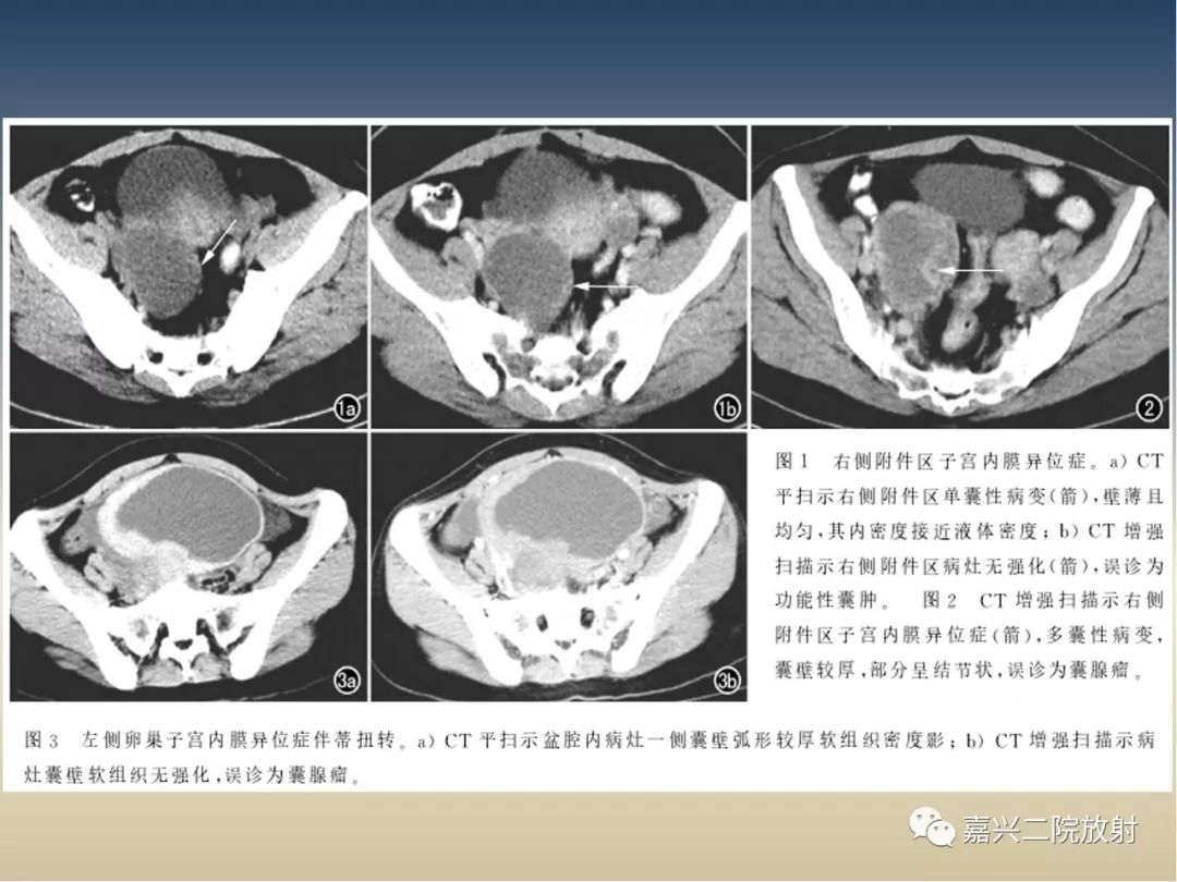 影像PPT - 【PPT】子宫内膜异位症-17
