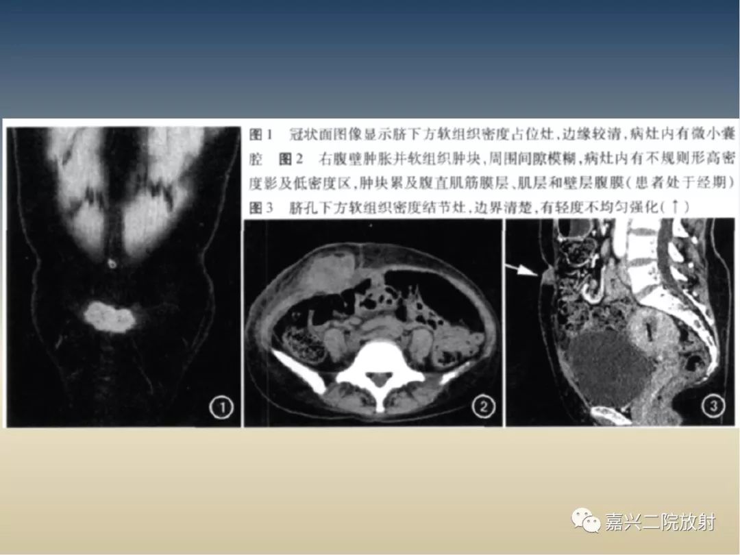 影像PPT - 【PPT】子宫内膜异位症-22