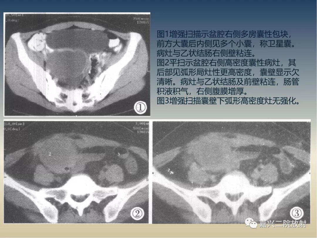 影像PPT - 【PPT】子宫内膜异位症-18