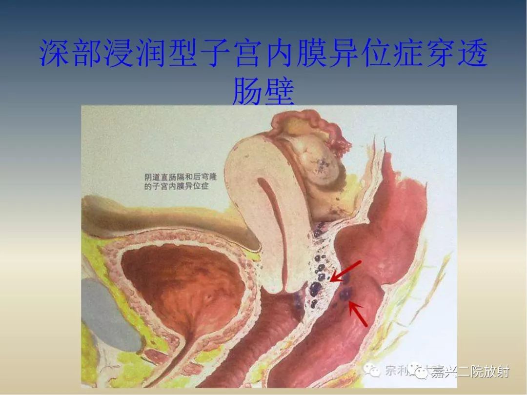 影像PPT - 【PPT】子宫内膜异位症-28