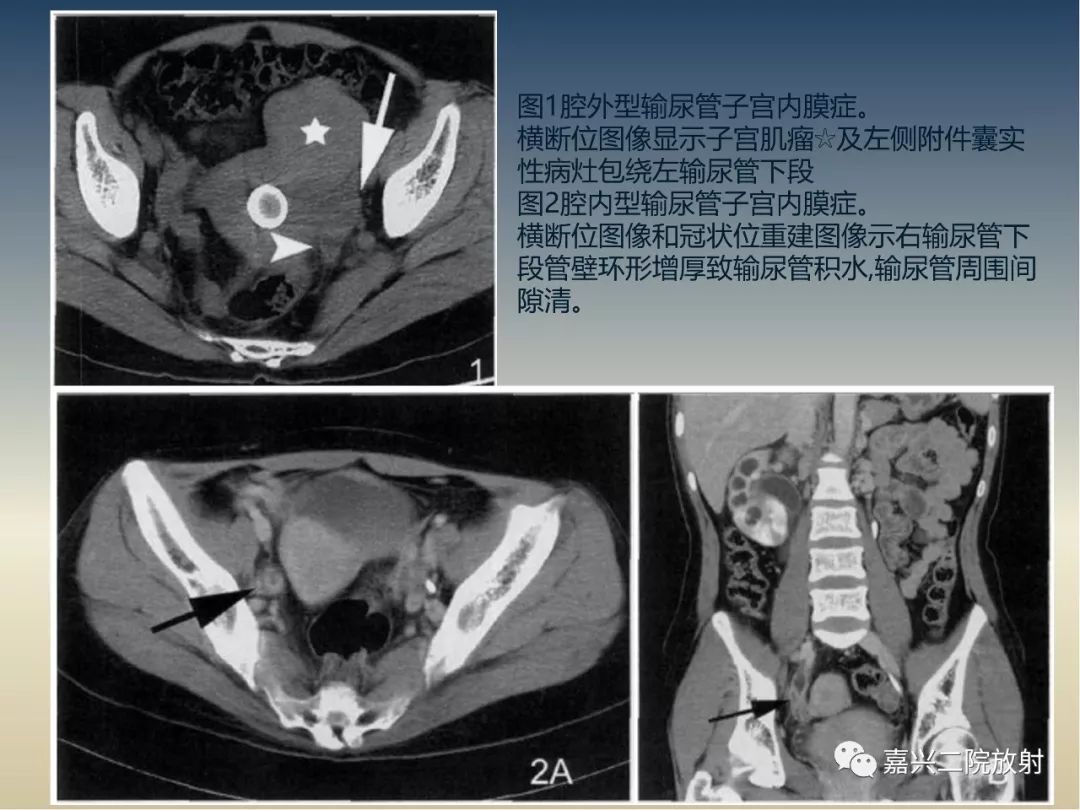 影像PPT - 【PPT】子宫内膜异位症-32