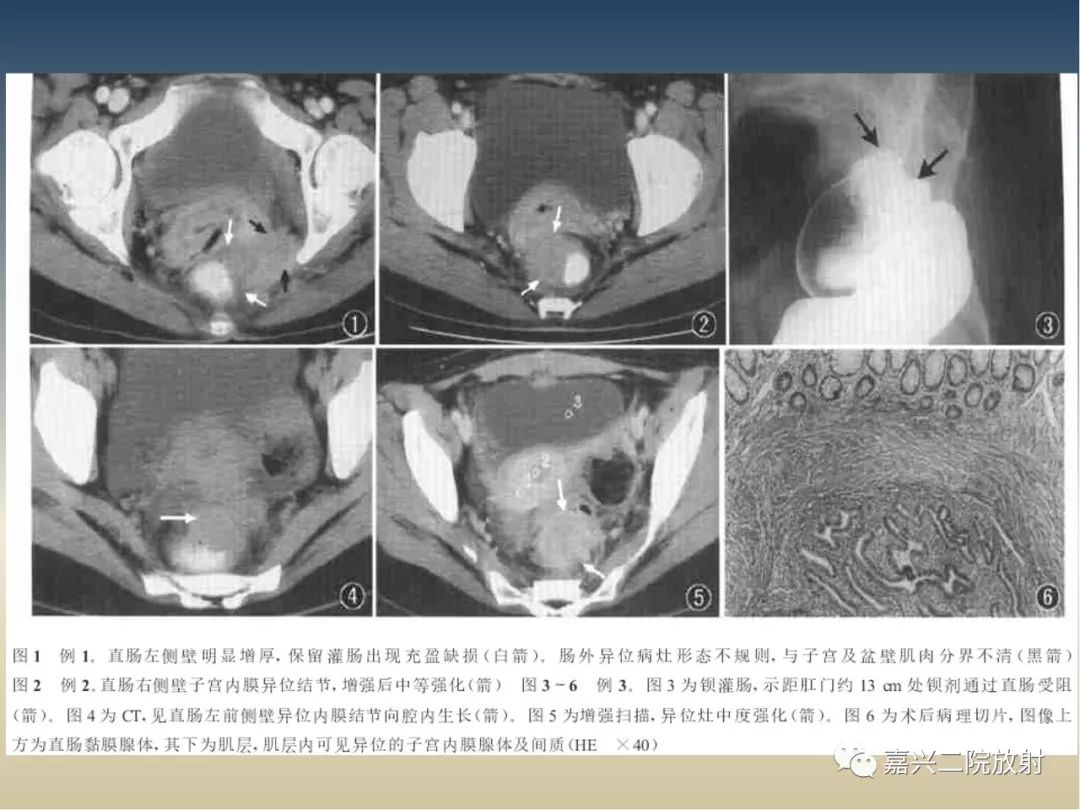 影像PPT - 【PPT】子宫内膜异位症-29