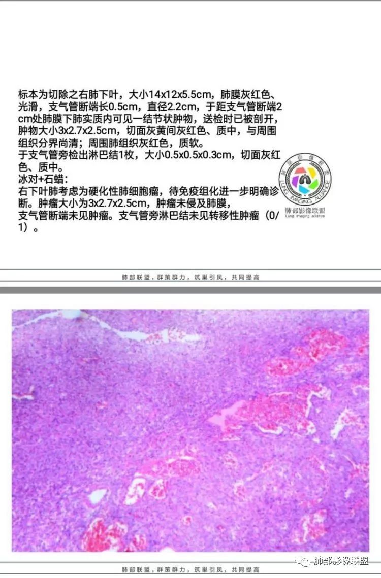 影像PPT - 【病例】硬化性肺细胞瘤1例CT影像-20 影像PPT - 【病例】硬化性肺细胞瘤1例CT影像-20