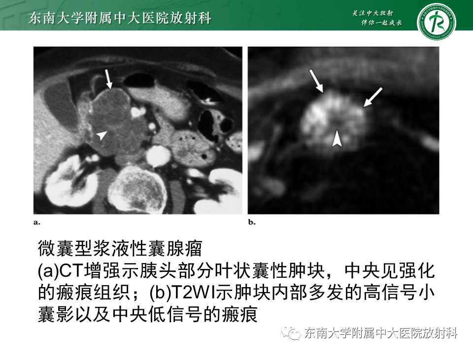 影像PPT - 【PPT】胰腺常见囊性病灶的鉴别诊断-10