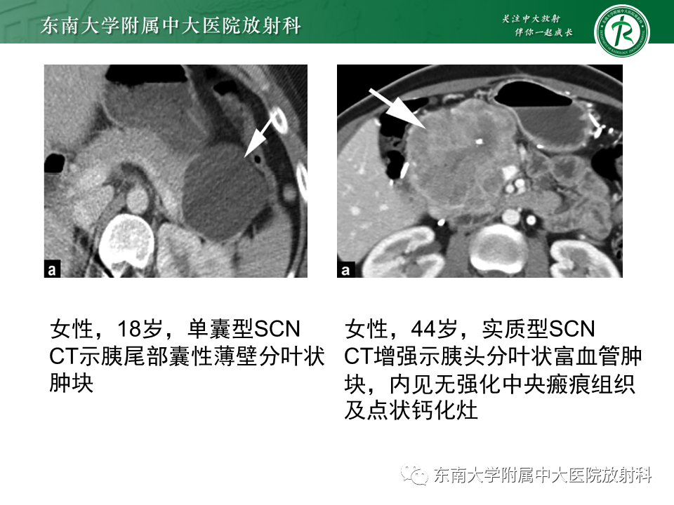 影像PPT - 【PPT】胰腺常见囊性病灶的鉴别诊断-12