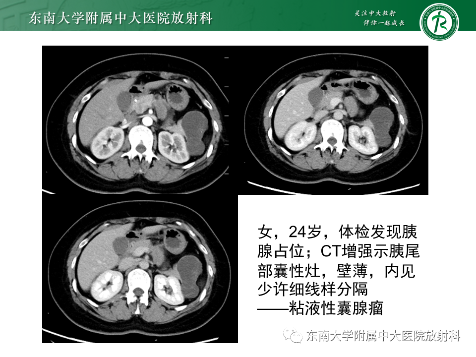 影像PPT - 【PPT】胰腺常见囊性病灶的鉴别诊断-13
