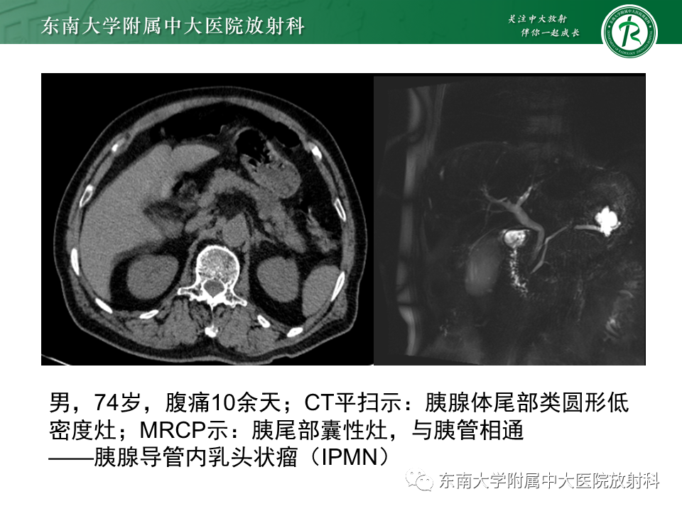影像PPT - 【PPT】胰腺常见囊性病灶的鉴别诊断-17