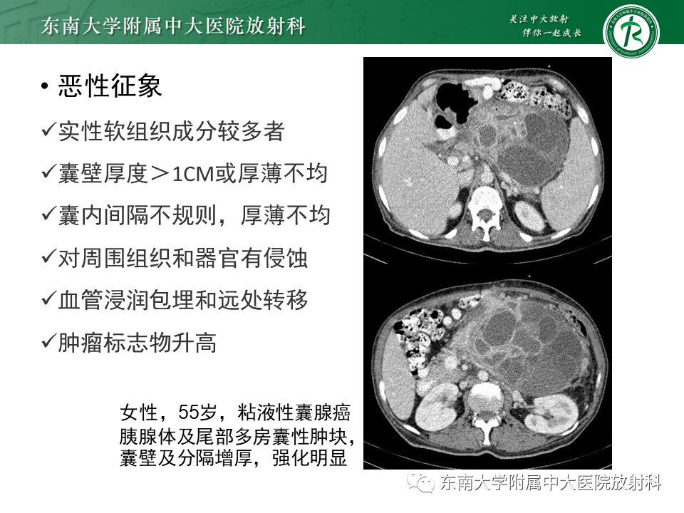影像PPT - 【PPT】胰腺常见囊性病灶的鉴别诊断-16