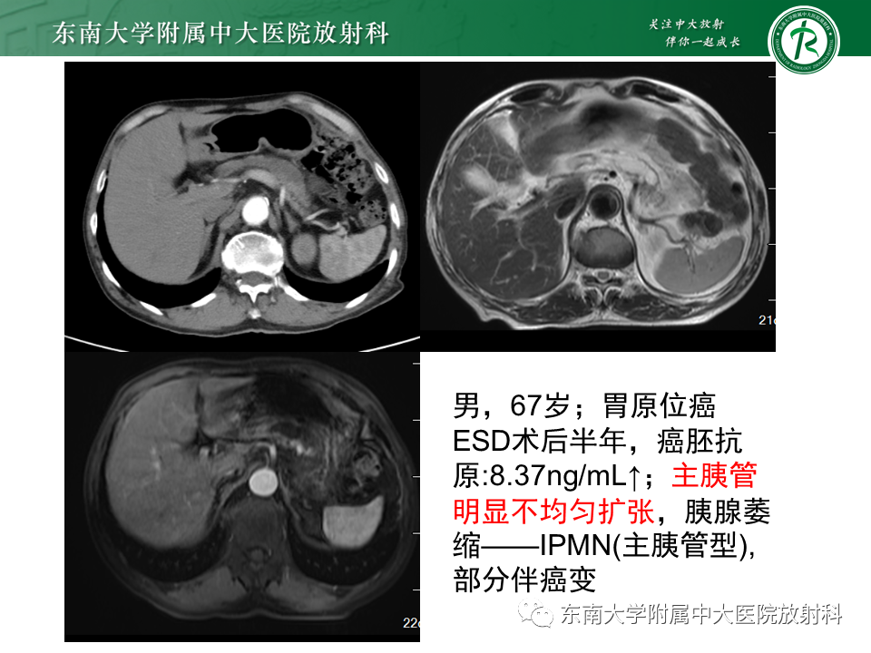 影像PPT - 【PPT】胰腺常见囊性病灶的鉴别诊断-21