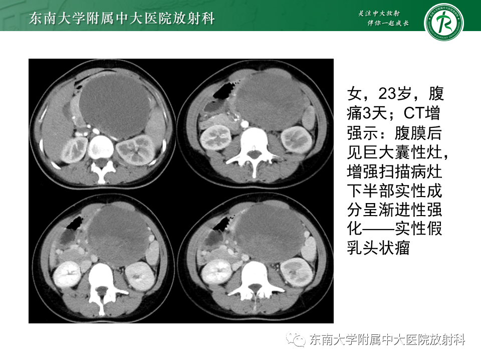 影像PPT - 【PPT】胰腺常见囊性病灶的鉴别诊断-24