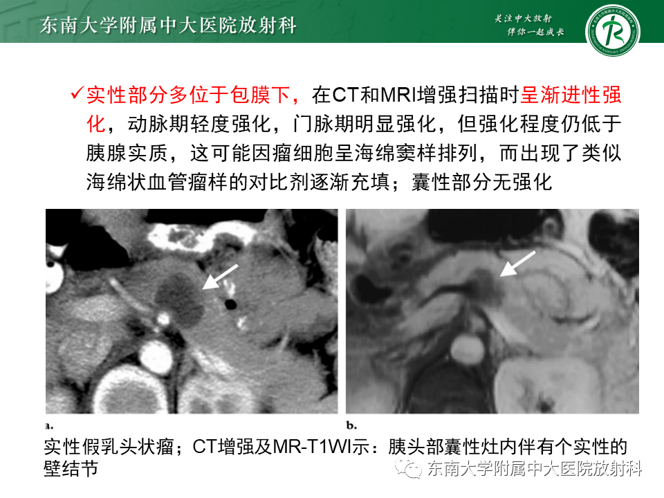 影像PPT - 【PPT】胰腺常见囊性病灶的鉴别诊断-27