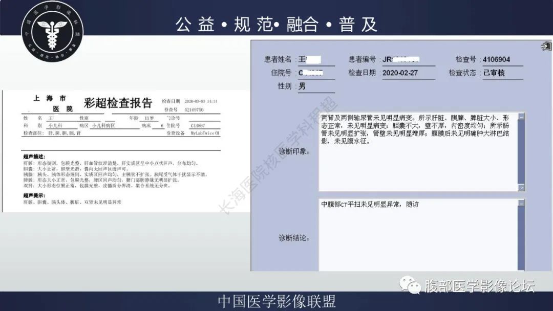 影像PPT - 【病例】小肠异位胃粘膜1例CT影像-4