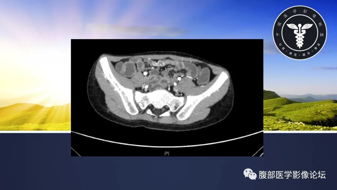 影像PPT - 【病例】小肠异位胃粘膜1例CT影像-11