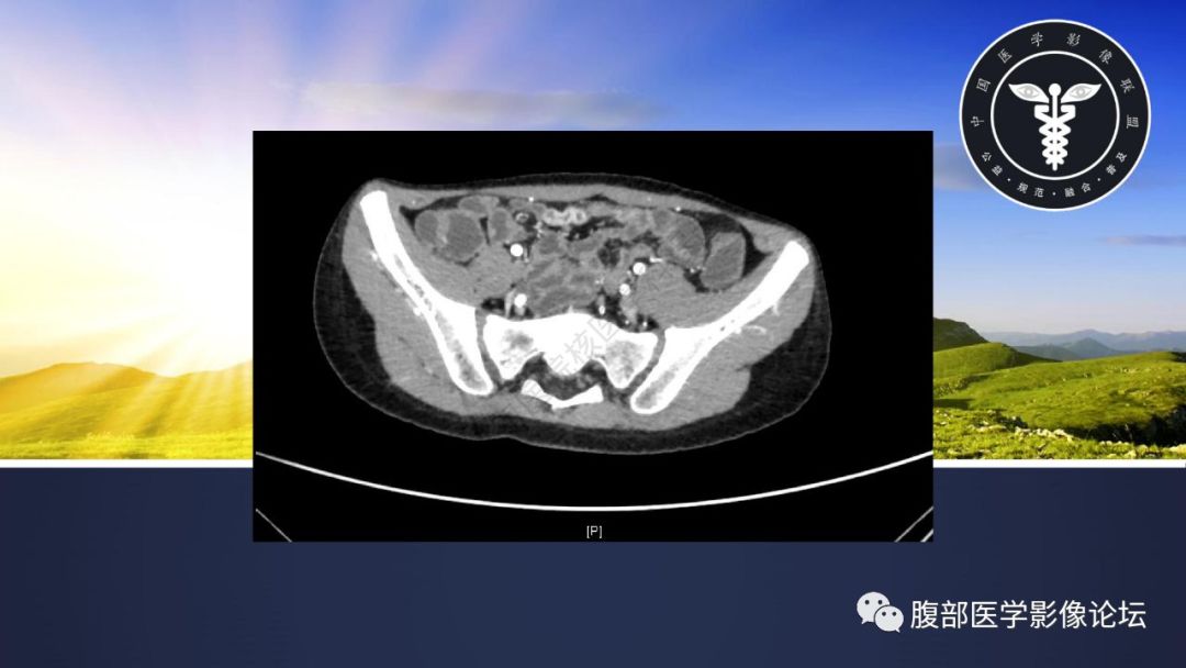 影像PPT - 【病例】小肠异位胃粘膜1例CT影像-12