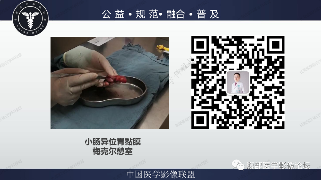 影像PPT - 【病例】小肠异位胃粘膜1例CT影像-18