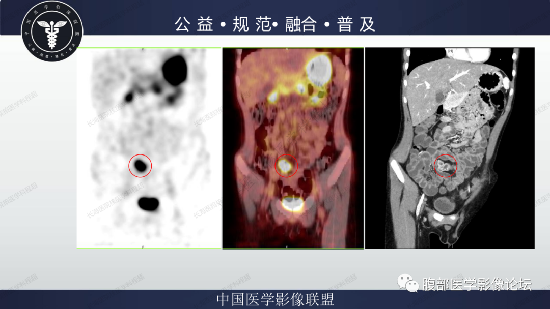 影像PPT - 【病例】小肠异位胃粘膜1例CT影像-19