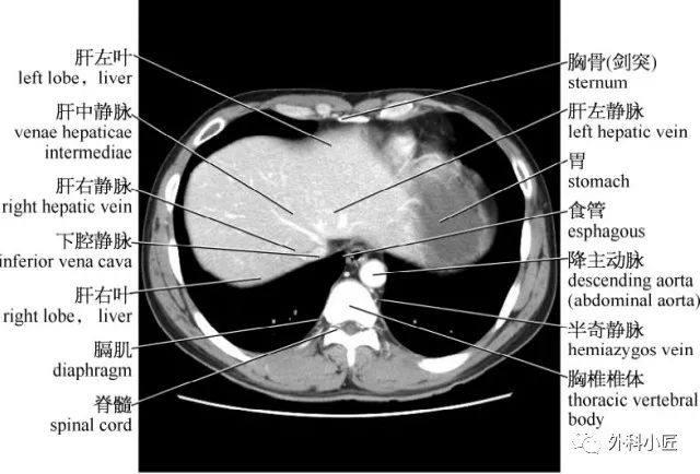 影像PPT - 46组对比图带你完全掌握腹部影像解剖-8 影像PPT - 46组对比图带你完全掌握腹部影像解剖-8