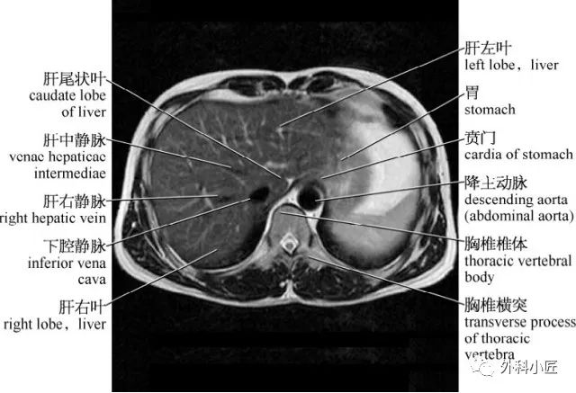 影像PPT - 46组对比图带你完全掌握腹部影像解剖-10 影像PPT - 46组对比图带你完全掌握腹部影像解剖-10