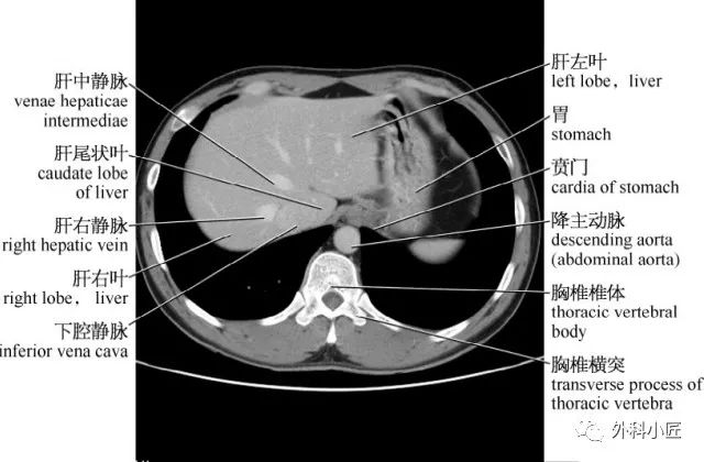 影像PPT - 46组对比图带你完全掌握腹部影像解剖-11 影像PPT - 46组对比图带你完全掌握腹部影像解剖-11
