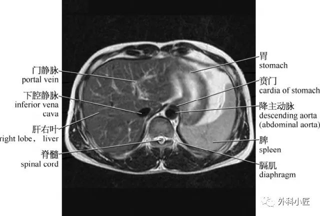 影像PPT - 46组对比图带你完全掌握腹部影像解剖-13 影像PPT - 46组对比图带你完全掌握腹部影像解剖-13