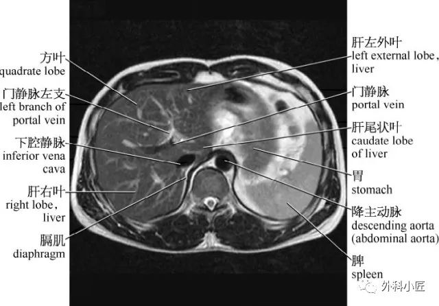 影像PPT - 46组对比图带你完全掌握腹部影像解剖-16 影像PPT - 46组对比图带你完全掌握腹部影像解剖-16