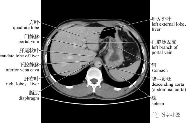 影像PPT - 46组对比图带你完全掌握腹部影像解剖-17 影像PPT - 46组对比图带你完全掌握腹部影像解剖-17
