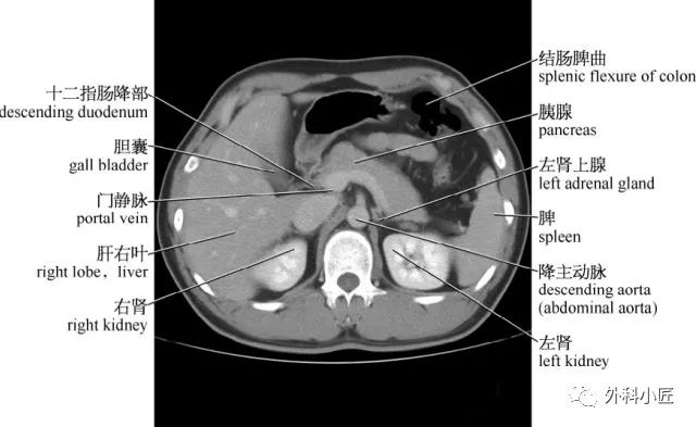 影像PPT - 46组对比图带你完全掌握腹部影像解剖-23 影像PPT - 46组对比图带你完全掌握腹部影像解剖-23