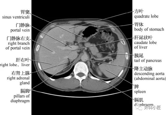 影像PPT - 46组对比图带你完全掌握腹部影像解剖-20 影像PPT - 46组对比图带你完全掌握腹部影像解剖-20