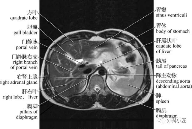 影像PPT - 46组对比图带你完全掌握腹部影像解剖-19 影像PPT - 46组对比图带你完全掌握腹部影像解剖-19