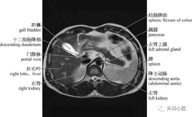 影像PPT - 46组对比图带你完全掌握腹部影像解剖-22 影像PPT - 46组对比图带你完全掌握腹部影像解剖-22