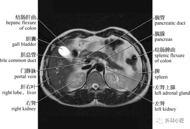 影像PPT - 46组对比图带你完全掌握腹部影像解剖-25 影像PPT - 46组对比图带你完全掌握腹部影像解剖-25