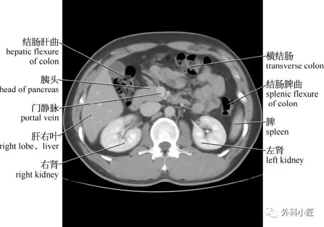 影像PPT - 46组对比图带你完全掌握腹部影像解剖-29 影像PPT - 46组对比图带你完全掌握腹部影像解剖-29