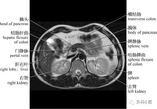 影像PPT - 46组对比图带你完全掌握腹部影像解剖-28 影像PPT - 46组对比图带你完全掌握腹部影像解剖-28