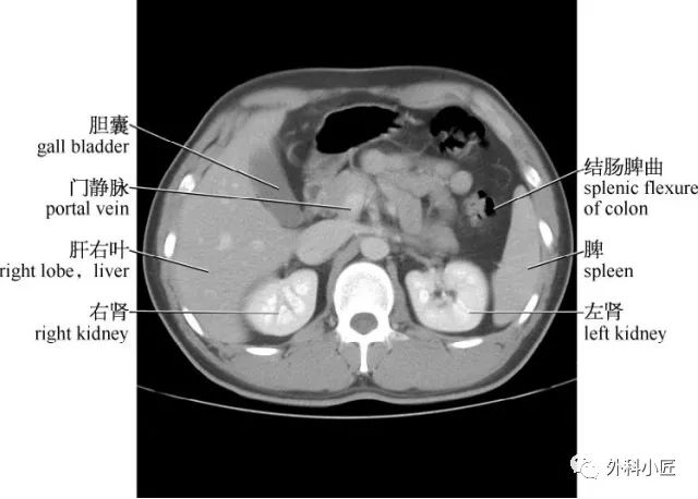 影像PPT - 46组对比图带你完全掌握腹部影像解剖-26 影像PPT - 46组对比图带你完全掌握腹部影像解剖-26