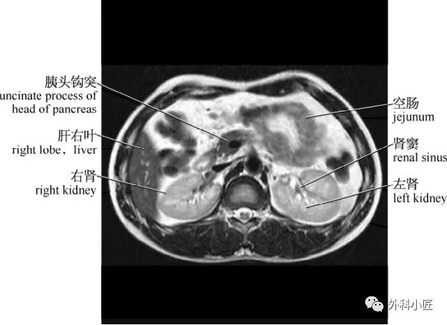 影像PPT - 46组对比图带你完全掌握腹部影像解剖-31 影像PPT - 46组对比图带你完全掌握腹部影像解剖-31