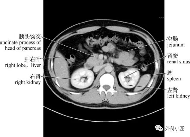 影像PPT - 46组对比图带你完全掌握腹部影像解剖-32 影像PPT - 46组对比图带你完全掌握腹部影像解剖-32