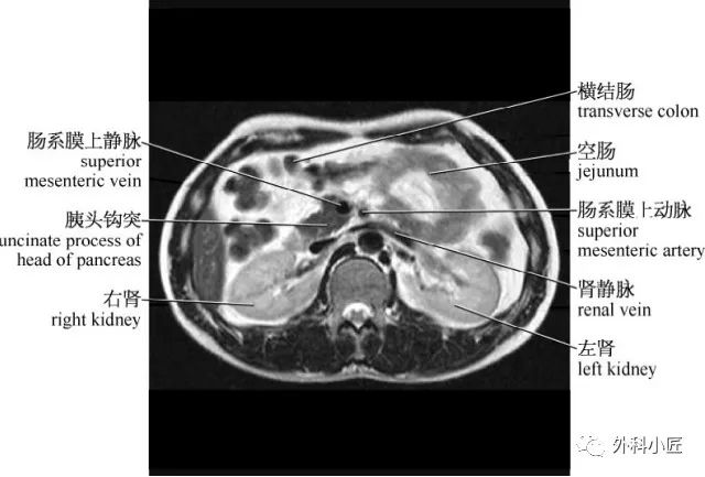 影像PPT - 46组对比图带你完全掌握腹部影像解剖-34 影像PPT - 46组对比图带你完全掌握腹部影像解剖-34