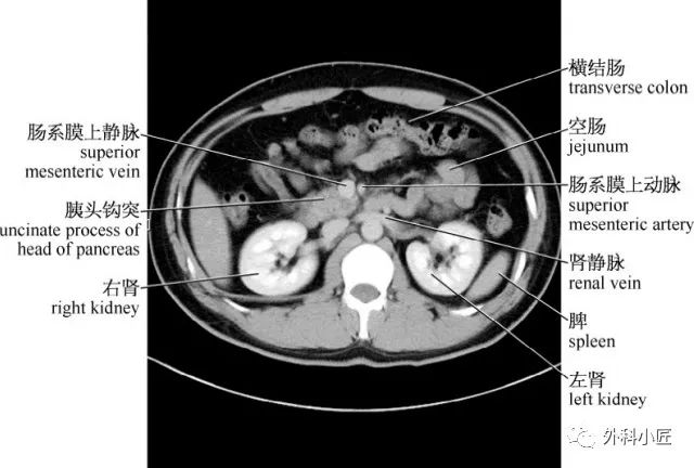 影像PPT - 46组对比图带你完全掌握腹部影像解剖-35 影像PPT - 46组对比图带你完全掌握腹部影像解剖-35