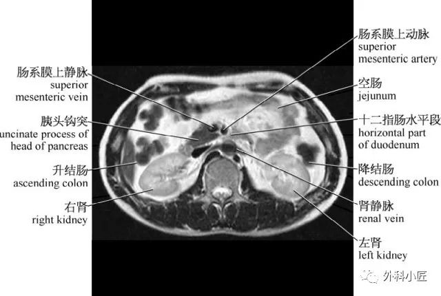 影像PPT - 46组对比图带你完全掌握腹部影像解剖-37 影像PPT - 46组对比图带你完全掌握腹部影像解剖-37
