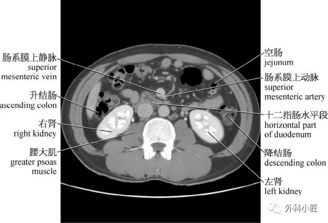 影像PPT - 46组对比图带你完全掌握腹部影像解剖-41 影像PPT - 46组对比图带你完全掌握腹部影像解剖-41