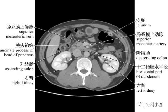 影像PPT - 46组对比图带你完全掌握腹部影像解剖-38 影像PPT - 46组对比图带你完全掌握腹部影像解剖-38