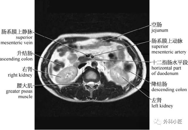 影像PPT - 46组对比图带你完全掌握腹部影像解剖-40 影像PPT - 46组对比图带你完全掌握腹部影像解剖-40