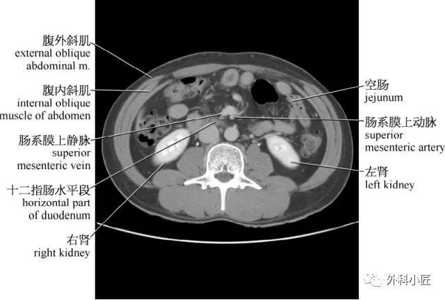 影像PPT - 46组对比图带你完全掌握腹部影像解剖-47 影像PPT - 46组对比图带你完全掌握腹部影像解剖-47
