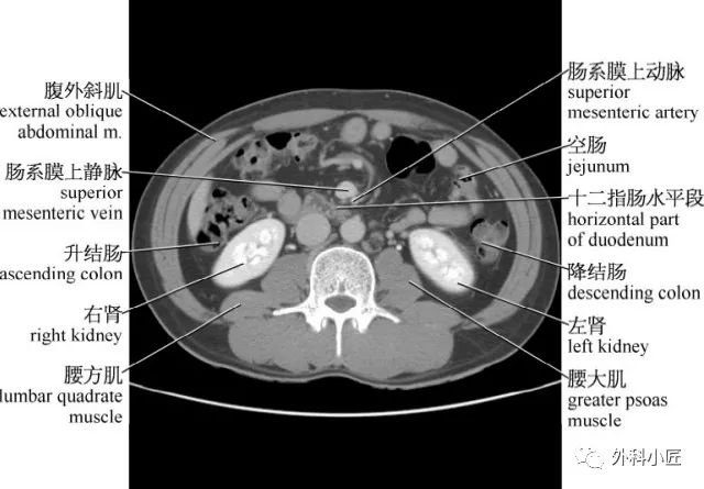 影像PPT - 46组对比图带你完全掌握腹部影像解剖-44 影像PPT - 46组对比图带你完全掌握腹部影像解剖-44