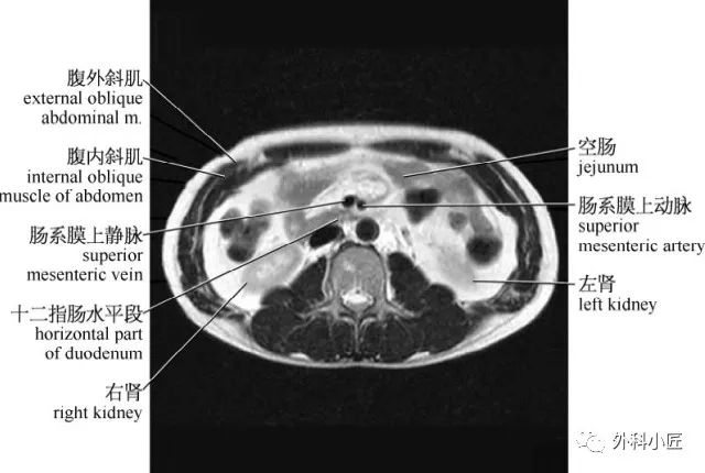 影像PPT - 46组对比图带你完全掌握腹部影像解剖-46 影像PPT - 46组对比图带你完全掌握腹部影像解剖-46